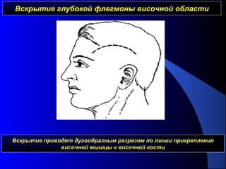 Вскрытие глубокой флегмоны височной областиВскрытие глубокой флегмоны височной области
Вскрытие проводят дугообразным разрезом по линии прикрепления
височной мышцы к височной кости
 