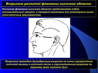 Вскрытие разлитой флегмоны височной областиВскрытие разлитой флегмоны височной области
Вскрытие проводят дугообразным разрезом по линии прикрепления
височной мышцы к височной кости и горизонтальным разрезом по
верхнему краю скуловой дуги
Разлитая флегмона височной области представляет собой
воспалительный процесс, в который вовлечены все упомянутые выше
клетчаточные пространства
 