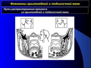 Флегмоны крылонебной и подвисочной ямокФлегмоны крылонебной и подвисочной ямок
Пути распространения процесса
из крылонебной и подвисочной ямки
 