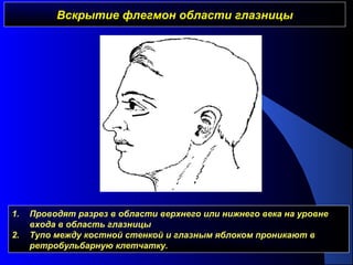 Вскрытие флегмон области глазницыВскрытие флегмон области глазницы
1. Проводят разрез в области верхнего или нижнего века на уровне
входа в область глазницы
2. Тупо между костной стенкой и глазным яблоком проникают в
ретробульбарную клетчатку.
 
