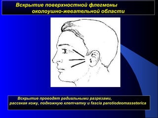 Вскрытие поверхностной флегмоныВскрытие поверхностной флегмоны
околоушно-жевательной областиоколоушно-жевательной области
Вскрытие проводят радиальными разрезами,
рассекая кожу, подкожную клетчатку и fascia parotiodeomasseterica
 