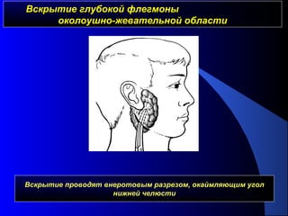 Вскрытие глубокой флегмоныВскрытие глубокой флегмоны
околоушно-жевательной областиоколоушно-жевательной области
Вскрытие проводят внеротовым разрезом, окаймляющим угол
нижней челюсти
 