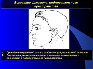 Вскрытие флегмоны поджевательногоВскрытие флегмоны поджевательного
пространствапространства
1. Проводят внеротовой разрез, окаймляющий угол нижней челюсти.
2. Отсекают сухожилие m.masseter в месте ее прикрепления и
проникают в поджевательное пространство.
 