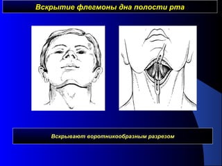 Вскрытие флегмоны дна полости ртаВскрытие флегмоны дна полости рта
Вскрывают воротникообразным разрезом
 