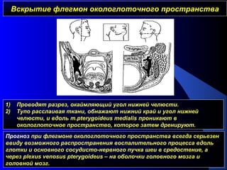 Вскрытие флегмон окологлоточного пространстваВскрытие флегмон окологлоточного пространства
1) Проводят разрез, окаймляющий угол нижней челюсти.
2) Тупо расслаивая ткани, обнажают нижний край и угол нижней
челюсти, и вдоль m.pterygoideus medialis проникают в
окологлоточное пространство, которое затем дренируют.
Прогноз при флегмоне окологлоточного пространства всегда серьезен
ввиду возможного распространения воспалительного процесса вдоль
глотки и основного сосудисто-нервного пучка шеи в средостение, а
через plexus venosus pterygoideus – на оболочки головного мозга и
головной мозг.
 