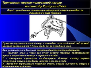 Трепанация верхне-челюстной пазухиТрепанация верхне-челюстной пазухи
по способу Колдуэлл-Люкапо способу Колдуэлл-Люка
Перед проведением трепанации гайморовой пазухи проводят ее
диагностическую пункцию.
Пункцию верхне-челюстной пазухи проводят толстой иглой под нижней
носовой раковиной, на 1-1,5 см кзади от ее переднего края.
При установлении диагноза острого одонтогенного гайморита:
1 – удаляют клык и через его лунку ввести троакар, пробуравливая
лунку в направлении кверху, к середине и кзади.
2 - изогнутым троакаром перфорируют боковую стенку верхне-
челюстной пазухи в пределах нижнего носового хода.
3 - проводят трепанацию передней стенки верхне-челюстной пазухи в
области клыковой ямки.
 