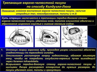 Трепанация верхне-челюстной пазухиТрепанация верхне-челюстной пазухи
по способу Колдуэлл-Люкапо способу Колдуэлл-Люка
Суть операции заключается в трепанации передне-боковой стенки
верхне-челюстной пазухи, удалении гноя, полипов слизистой оболочки и
образование широкого соустья с нижним носовым ходом.
1. Оттянув кверху верхнюю губу, проводят разрез слизистой оболочки
инадкостницы по переходной складке.
2. Отслаивают распатором кверху надкостницу, обнажая клыковую
ямку, чтобы не повредить сосудисто-нервный пучок выходящий
через foramen infraorbitalis.
3. Вскрывают передне-боковую стенку верхне-челюстной пазухи и
щипцами Люэра расширяют отверстие до нужных размеров. Из
пазухи удаляют гной, полипы и грануляции.
Показания: гнойное воспаление верхне-челюстной пазухи, наличие
инородных тел, новообразования, полипы и т.д.
 