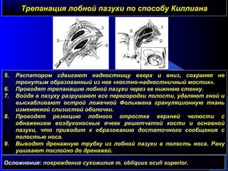 Трепанация лобной пазухи по способу КиллианаТрепанация лобной пазухи по способу Киллиана
5. Распатором сдвигают надкостницу вверх и вниз, сохраняя не
тронутым образованный из нее «костно-надкостничный мостик».
6. Проводят трепанацию лобной пазухи через ее нижнюю стенку.
7. Войдя в пазуху разрушают все перегородки полости, удаляют гной и
выскабливают острой ложечкой Фолькмана грануляционную ткань
измененной слизистой оболочки.
8. Проводят резекцию лобного отростка верхней челюсти с
обнажением воздухоносных ячеек решетчатой кости и основной
пазухи, что приводит к образованию достаточного сообщения с
полостью носа.
9. Выводят дренажную трубку из лобной пазухи в полость носа. Рану
ушивают послойно до дренажей.
Осложнения: повреждение сухожилия m. obliquus oculi superior.
 