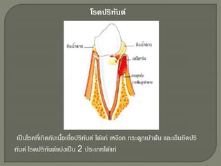 เป็นโรคที่เกิดกับเนื้อเยื่อปริทันต์ ได้แก่ เหงือก กระดูกเบ้าฟัน และเอ็นยึดปริ
ทันต์ โรคปริทันต์แบ่งเป็น 2 ประเภทได้แก่
โรคปริทันต์
 