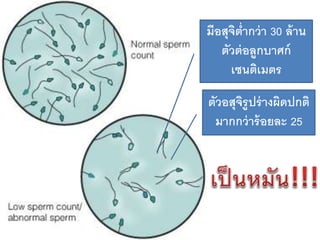 มีอสุจิต่ากว่า 30 ล้าน
ตัวต่อลูกบาศก์
เซนติเมตร
ตัวอสุจิรูปร่างผิดปกติ
มากกว่าร้อยละ 25
 