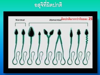 ผิดปกติมากกว่าร้อยละ 25
 