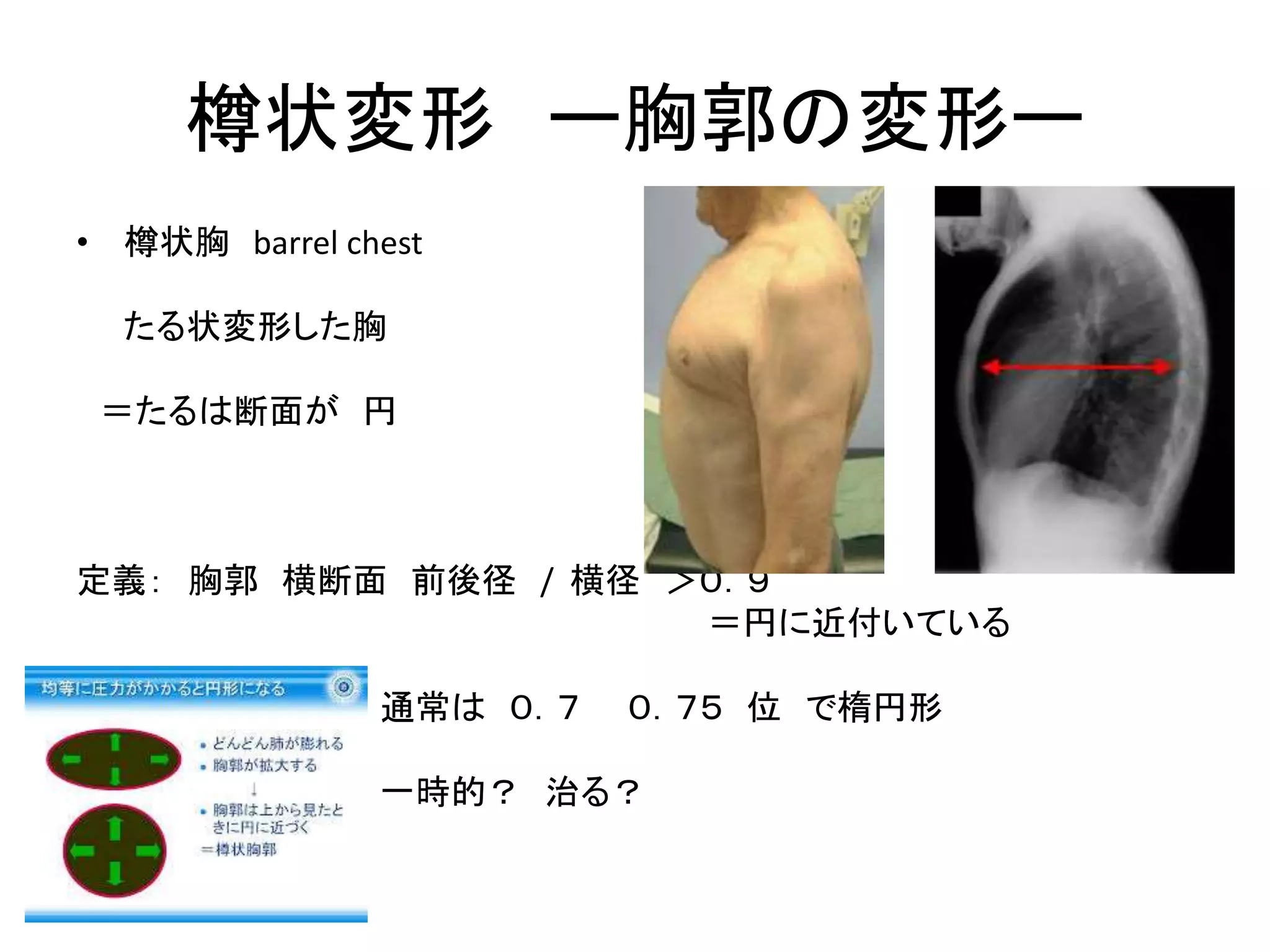 ２ ４肺の過膨張の機序樽状変形