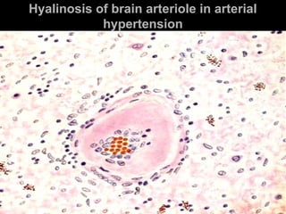Hyalinosis ooff bbrraaiinn aarrtteerriioollee iinn aarrtteerriiaall 
hhyyppeerrtteennssiioonn 
 