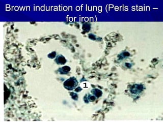 Brown induration ooff lluunngg ((PPeerrllss ssttaaiinn –– 
ffoorr iirroonn)) 
 