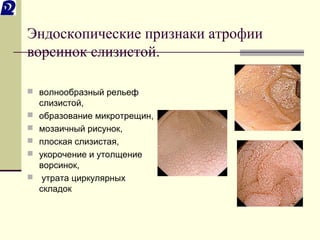 Эндоскопические признаки атрофии 
ворсинок слизистой. 
 волнообразный рельеф 
слизистой, 
 образование микротрещин, 
 мозаичный рисунок, 
 плоская слизистая, 
 укорочение и утолщение 
ворсинок, 
 утрата циркулярных 
складок 
 
