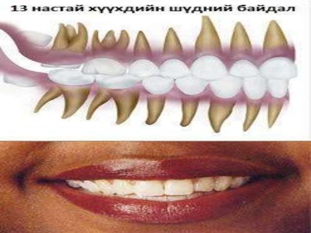 сүүн шүд болон байнгын шүдний онцлог