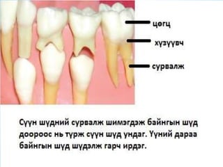 сүүн шүд болон байнгын шүдний онцлог | PPT