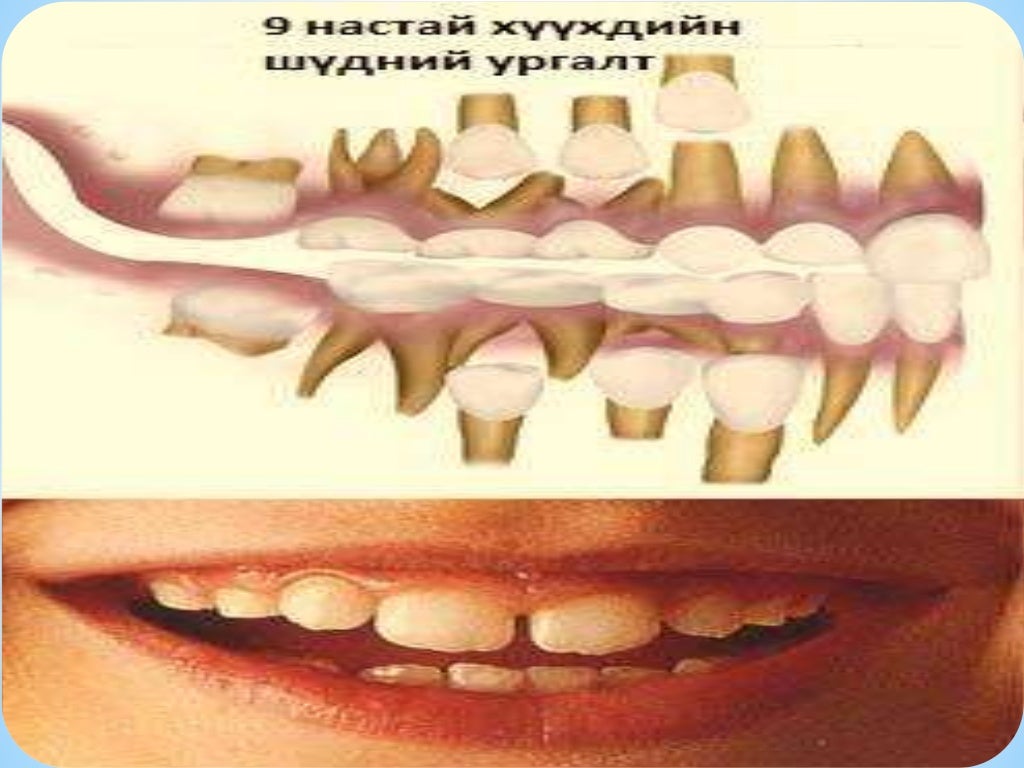 сүүн шүд болон байнгын шүдний онцлог