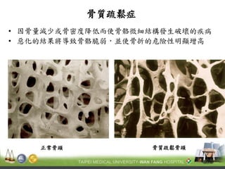 骨質疏鬆症 
•因骨量減少或骨密度降低而使骨骼微細結構發生破壞的疾病 
•惡化的結果將導致骨骼脆弱，並使骨折的危險性明顯增高 
骨質疏鬆骨頭 
正常骨頭  