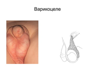 Варикоцеле 
 