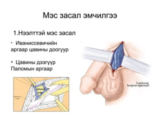 Мэс засал эмчилгээ 
1.Нээлттэй мэс засал 
• Иваниссевичийн 
аргаар цавины доогуур 
• Цавины дээгүүр 
Паломын аргаар 
 