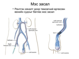 Мэс засал 
• Рентгэн хяналт доор төмсөгний өргөссөн 
венийн судсыг бөглөх мэс засал 
 