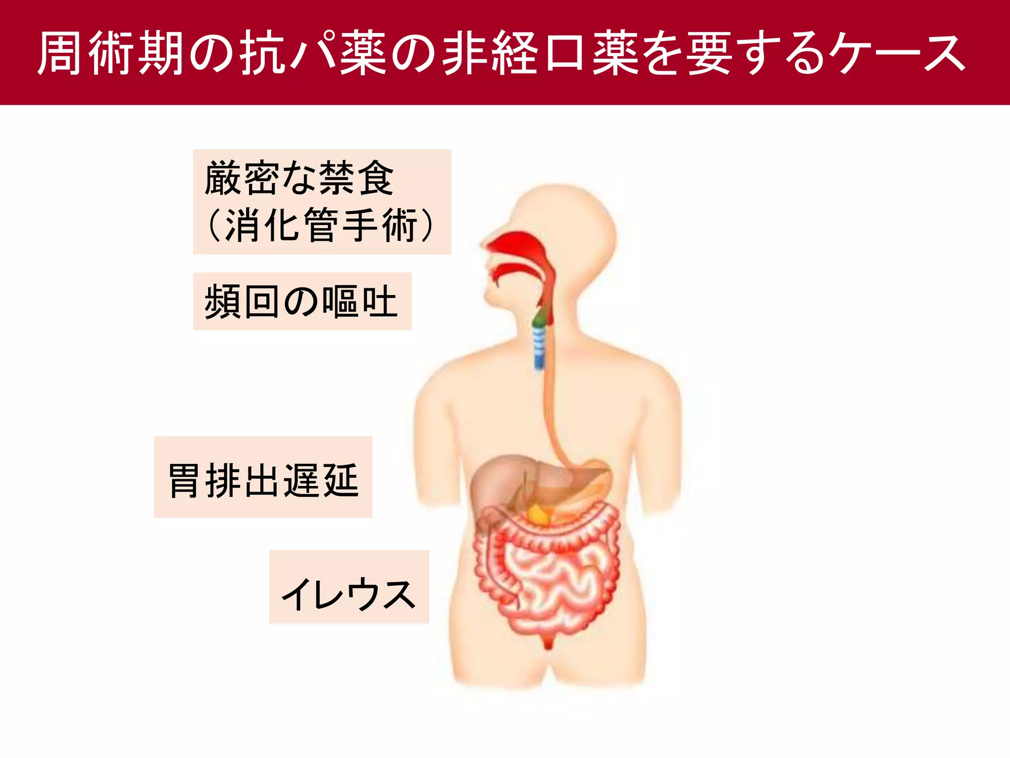 周術期の抗パ薬の非経口薬を要するケース 
厳密な禁食 
（消化管手術） 
頻回の嘔吐 
胃排出遅延 
イレウス 
 