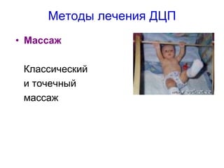 Методы лечения ДЦП 
•Массаж 
Классический 
и точечный 
массаж  