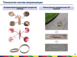 5 
Технологии систем визуализации 
Интерактивная визуализация сосудистой 
системы 
Реконструкция поверхностных 3D 
моделей 
 