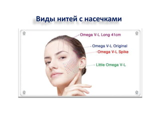 Виды нитей с насечками 
 