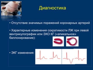 Диагностика 
• Отсутствие значимых поражений коронарных артерий 
• Характерные изменения сократимости ЛЖ при левой 
вентрикулографии или ЭХО КГ («апикальное» 
баллонирование): 
• ЭКГ изменения: 
 