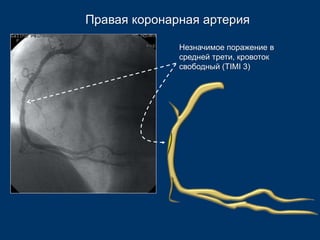 Правая коронарная артерия 
Незначимое поражение в 
средней трети, кровоток 
свободный (TIMI 3) 
 
