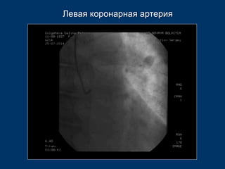 Левая коронарная артерия 
 