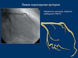Левая коронарная артерия 
Неровность контуров, кровоток 
свободный (TIMI 3) 
 