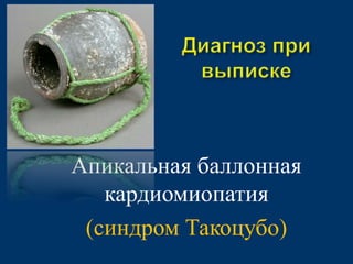 Апикальная баллонная 
кардиомиопатия 
(синдром Такоцубо) 
 