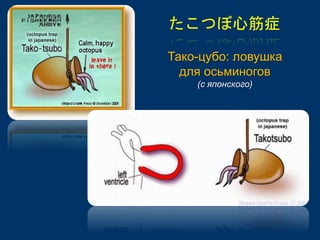 たこつぼ心筋症 
Тако-цубо: ловушка 
для осьминогов 
(с японского) 
 
