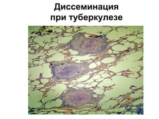 Диссеминация 
при туберкулезе 
 