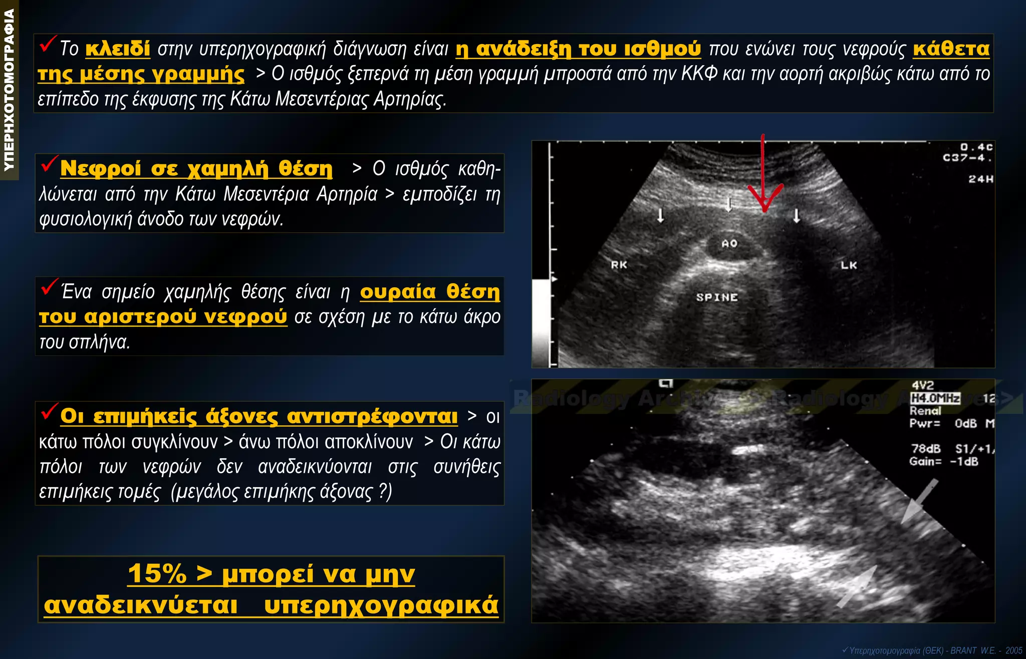 15% > μπορεί να μην αναδεικνύεται υπερηχογραφικά 
Το κλειδί στην υπερηχογραφική διάγνωση είναι η ανάδειξη του ισθμού που ενώνει τους νεφρούς κάθετα της μέσης γραμμής > Ο ισθμός ξεπερνά τη μέση γραμμή μπροστά από την ΚΚΦ και την αορτή ακριβώς κάτω από το επίπεδο της έκφυσης της Κάτω Μεσεντέριας Αρτηρίας. 
Νεφροί σε χαμηλή θέση > Ο ισθμός καθη- λώνεται από την Κάτω Μεσεντέρια Αρτηρία > εμποδίζει τη φυσιολογική άνοδο των νεφρών. 
Οι επιμήκεiς άξονες αντιστρέφονται > οι κάτω πόλοι συγκλίνουν > άνω πόλοι αποκλίνουν > Οι κάτω πόλοι των νεφρών δεν αναδεικνύονται στις συνήθεις επιμήκεις τομές (μεγάλος επιμήκης άξονας ?) 
Ένα σημείο χαμηλής θέσης είναι η ουραία θέση του αριστερού νεφρού σε σχέση με το κάτω άκρο του σπλήνα. ΥΠΕΡΗΧΟΤΟΜΟΓΡΑΦΙΑ 
Υπερηχοτομογραφία (ΘΕΚ) - BRANT W.E. - 2005  