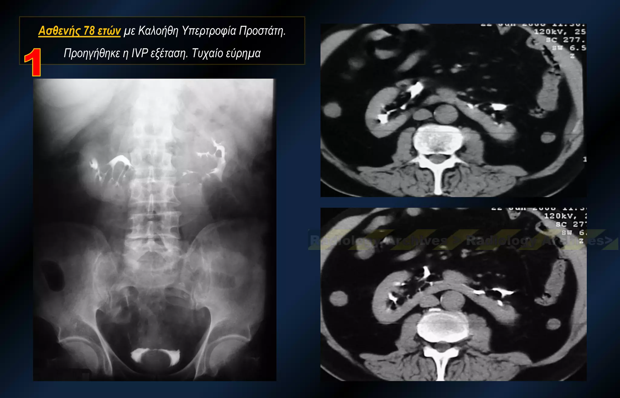 Ασθενής 78 ετών με Καλοήθη Υπερτροφία Προστάτη. Προηγήθηκε η IVP εξέταση. Τυχαίο εύρημα  