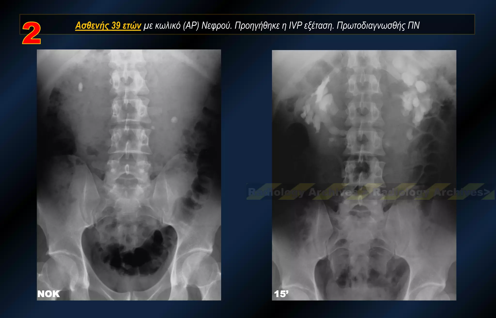 ΝΟΚ 
15’ 
Ασθενής 39 ετών με κωλικό (ΑΡ) Νεφρού. Προηγήθηκε η IVP εξέταση. Πρωτοδιαγνωσθής ΠΝ  