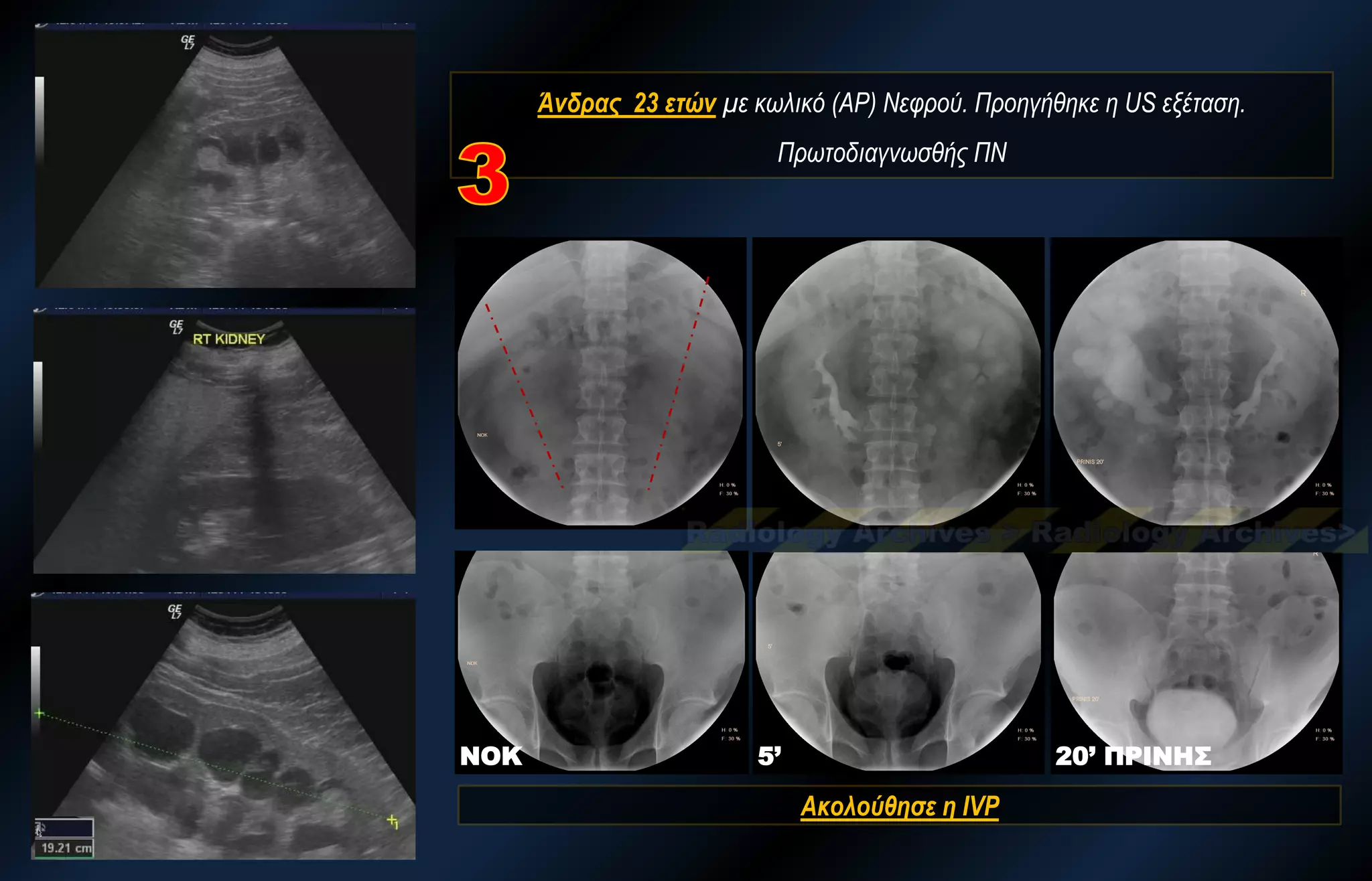 Άνδρας 23 ετών με κωλικό (ΑΡ) Νεφρού. Προηγήθηκε η US εξέταση. Πρωτοδιαγνωσθής ΠΝ 
ΝΟΚ 
5’ 
20’ ΠΡΙΝΗΣ 
Aκολούθησε η IVP  