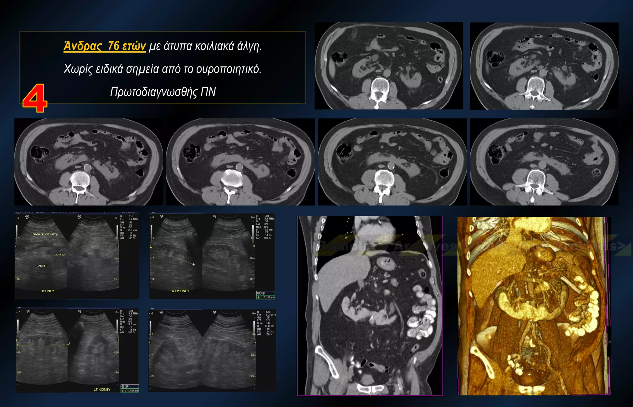 Άνδρας 76 ετών με άτυπα κοιλιακά άλγη. Χωρίς ειδικά σημεία από το ουροποιητικό. Πρωτοδιαγνωσθής ΠΝ  