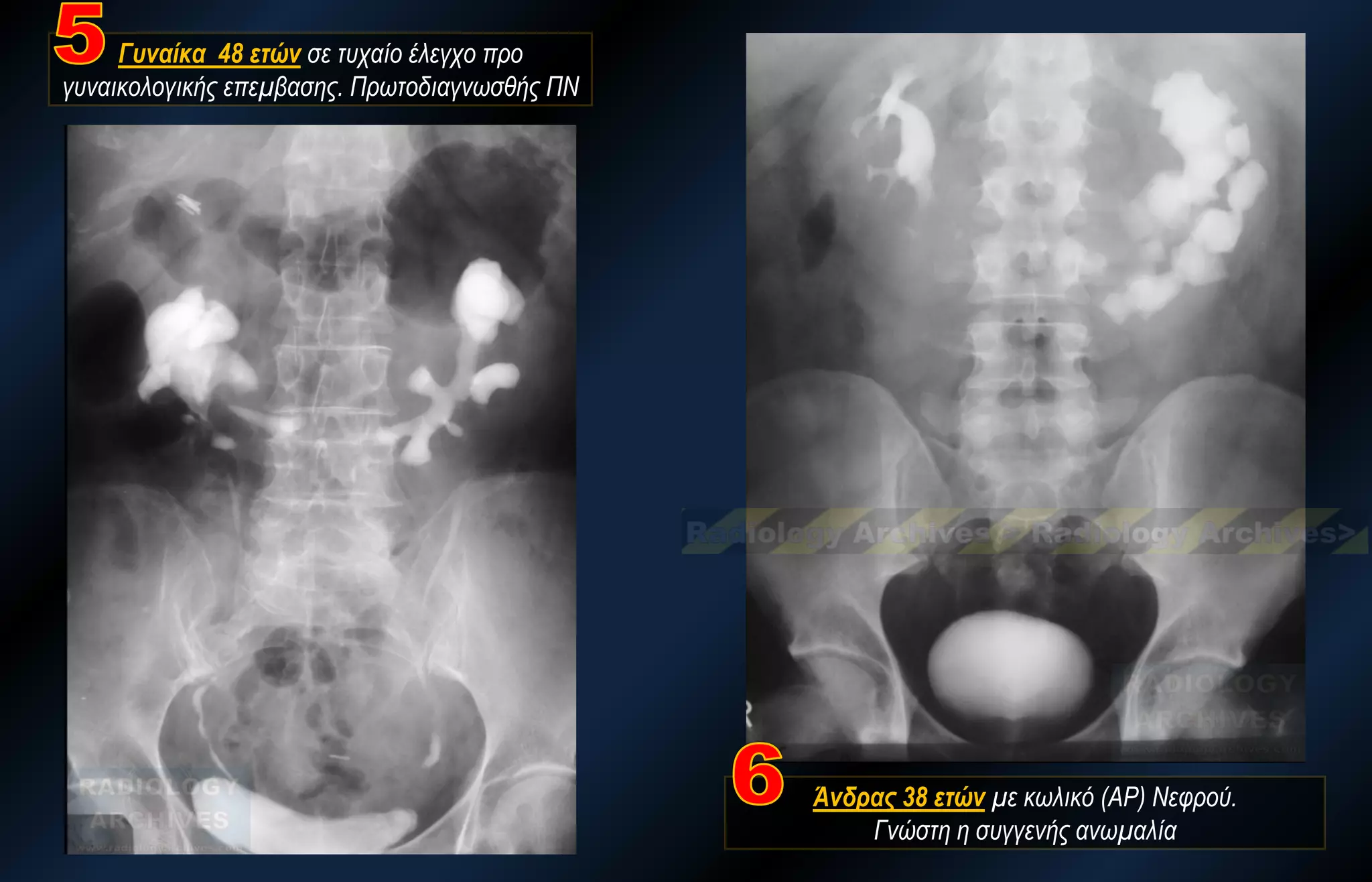 Γυναίκα 48 ετών σε τυχαίο έλεγχο προ γυναικολογικής επεμβασης. Πρωτοδιαγνωσθής ΠΝ 
Άνδρας 38 ετών με κωλικό (ΑΡ) Νεφρού. Γνώστη η συγγενής ανωμαλία  