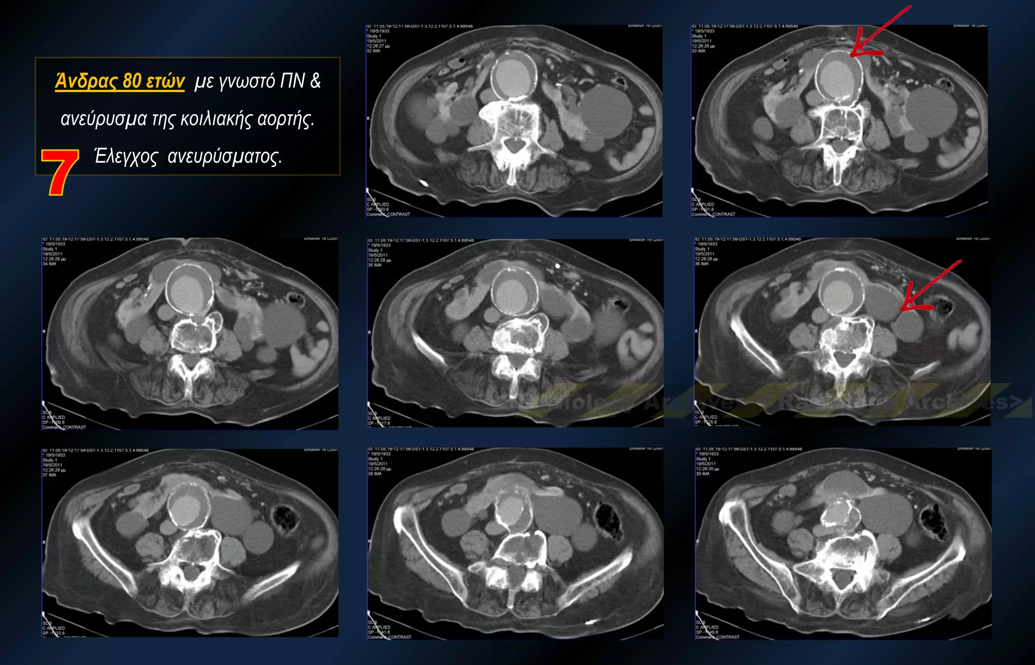 Άνδρας 80 ετών με γνωστό ΠΝ & ανεύρυσμα της κοιλιακής αορτής. Έλεγχος ανευρύσματος.  