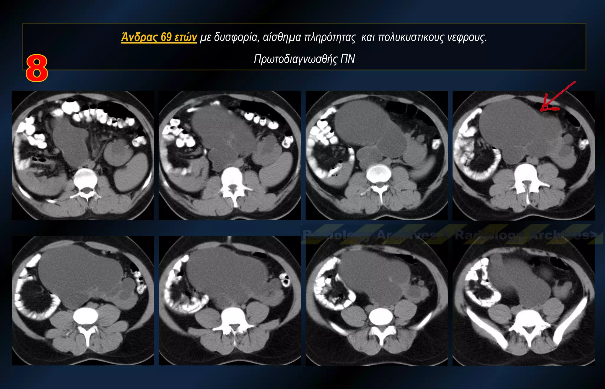 Άνδρας 69 ετών με δυσφορία, αίσθημα πληρότητας και πολυκυστικους νεφρους. Πρωτοδιαγνωσθής ΠΝ  