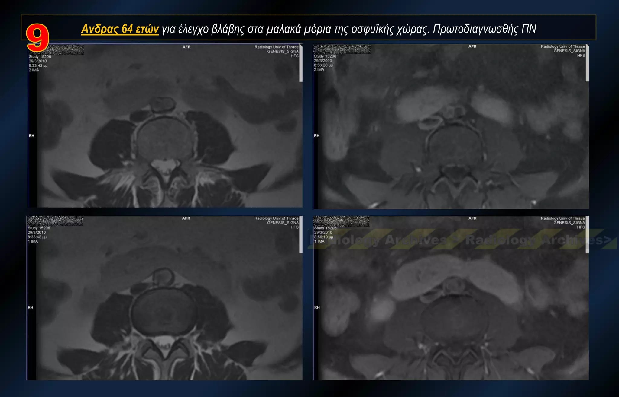 Ανδρας 64 ετών για έλεγχο βλάβης στα μαλακά μόρια της οσφυϊκής χώρας. Πρωτοδιαγνωσθής ΠΝ  