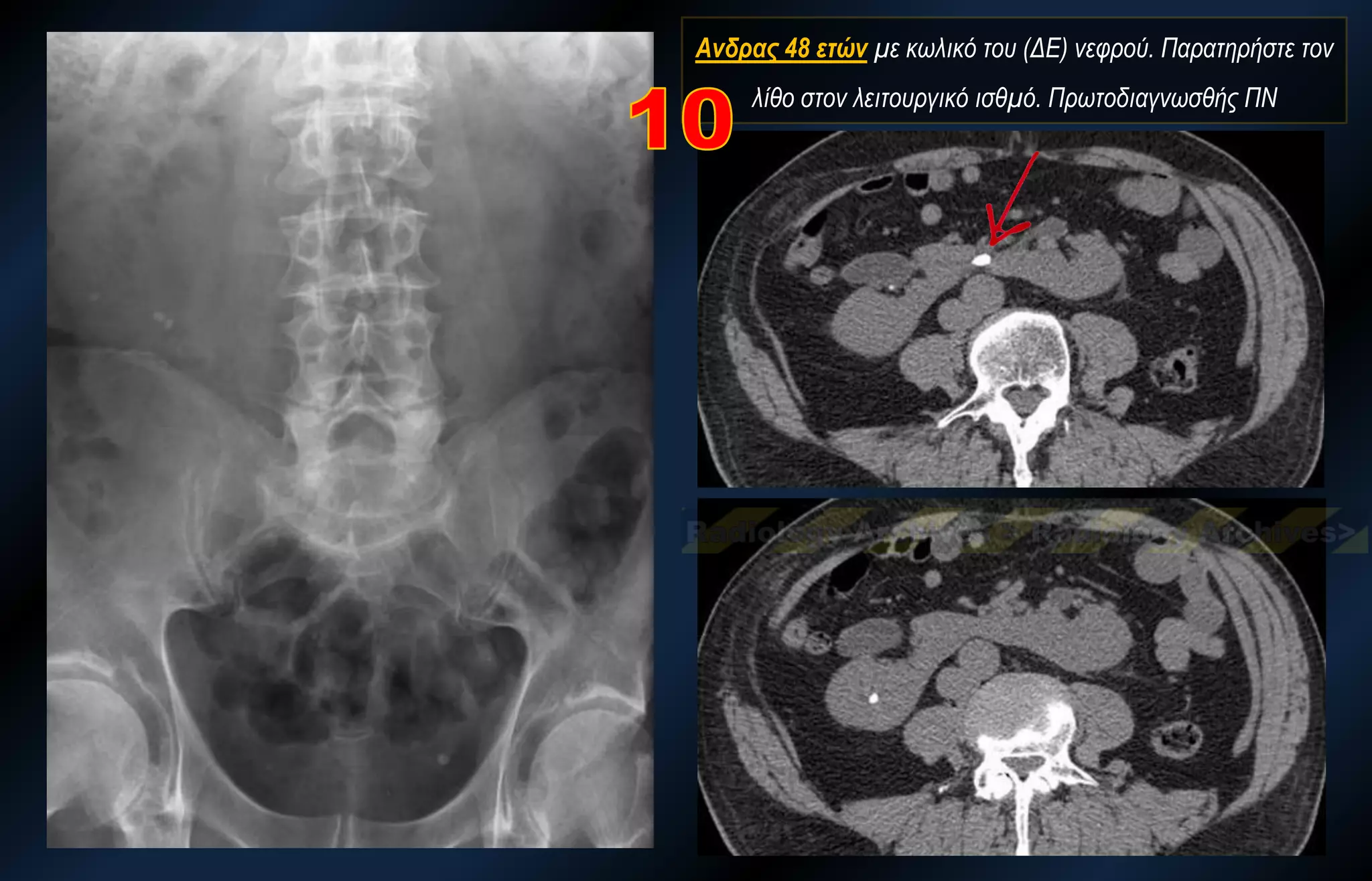 Ανδρας 48 ετών με κωλικό του (ΔΕ) νεφρού. Παρατηρήστε τον λίθο στον λειτουργικό ισθμό. Πρωτοδιαγνωσθής ΠΝ  