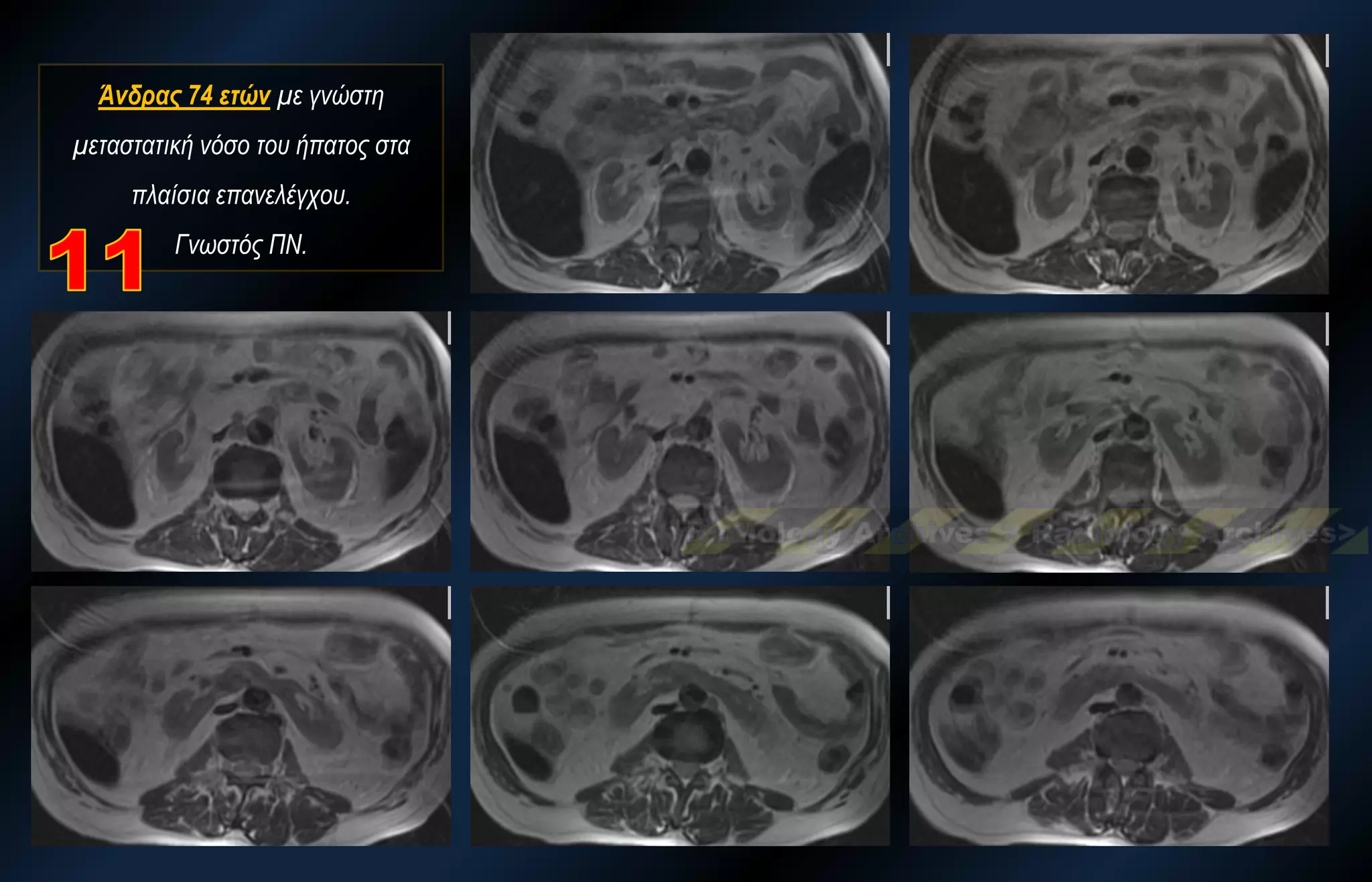 Άνδρας 74 ετών με γνώστη μεταστατική νόσο του ήπατος στα πλαίσια επανελέγχου. Γνωστός ΠΝ.  
