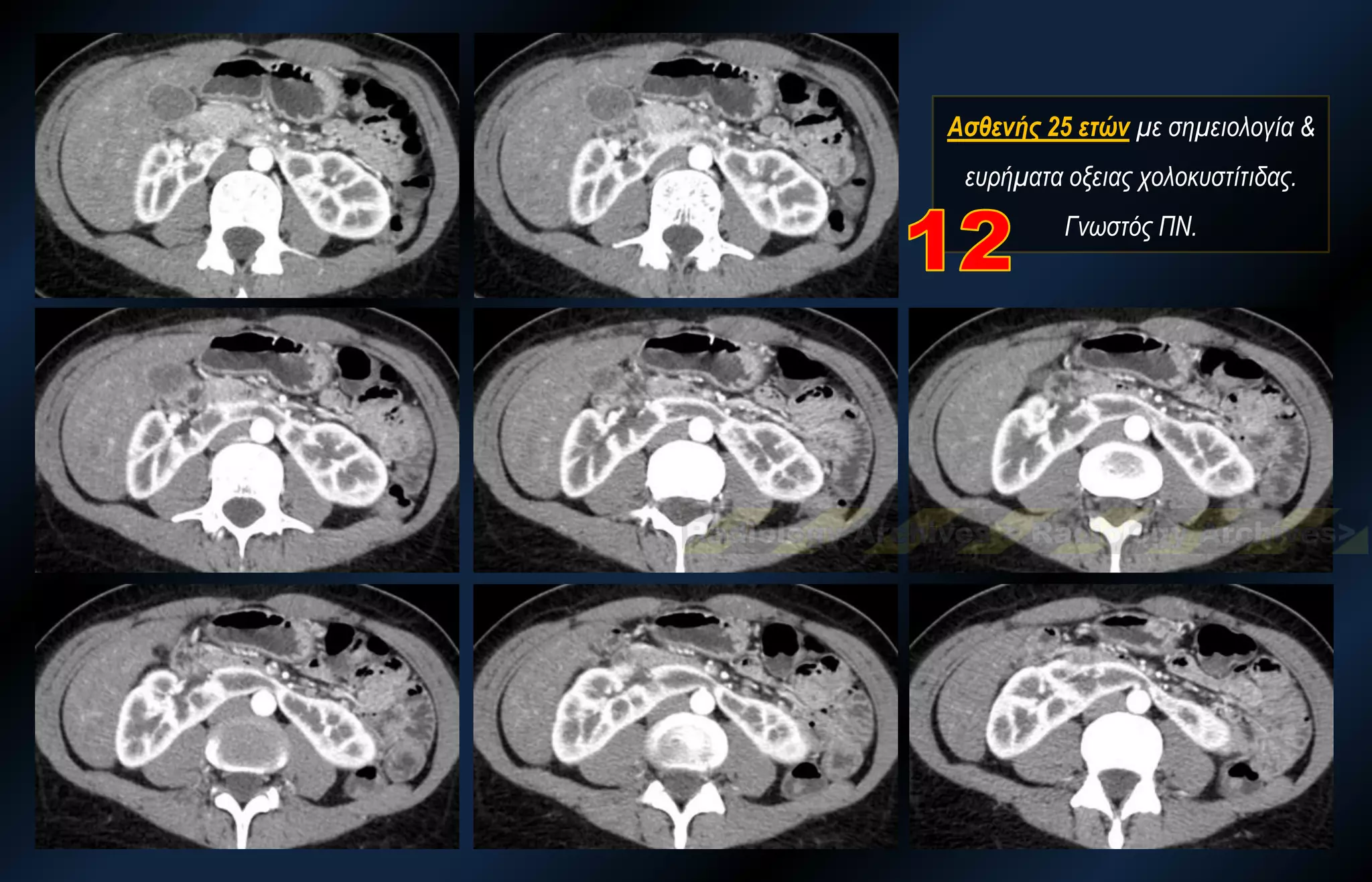 Ασθενής 25 ετών με σημειολογία & ευρήματα οξειας χολοκυστίτιδας. Γνωστός ΠΝ.  