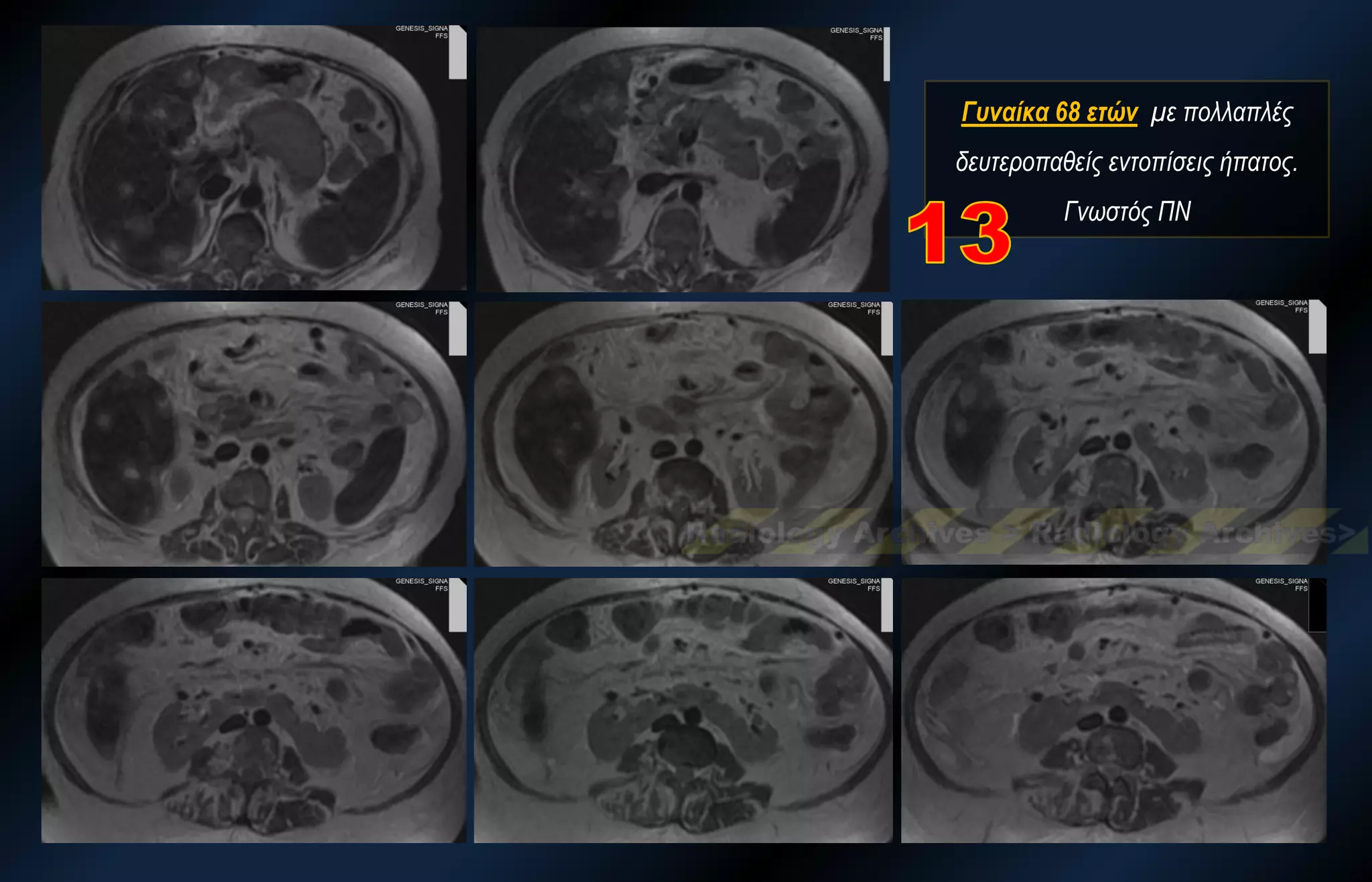 Γυναίκα 68 ετών με πολλαπλές δευτεροπαθείς εντοπίσεις ήπατος. Γνωστός ΠΝ  